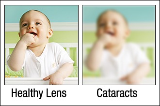 Cataracts before and after